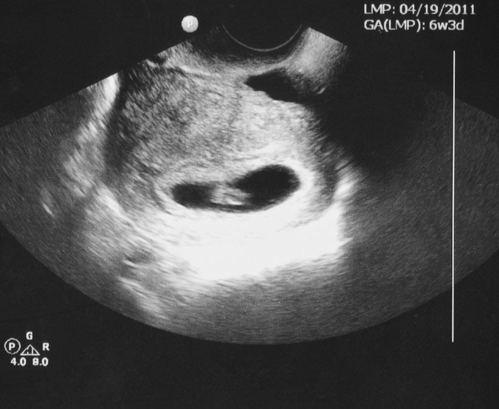 no heartbeat at 6 weeks pregnant